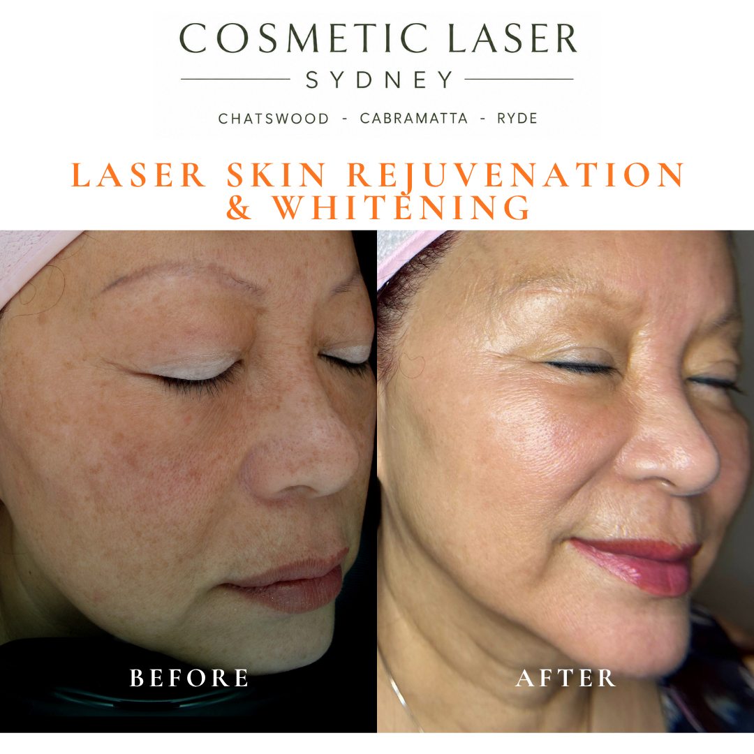 Before and after laser melasma freckle pigmentation treatment and skin whitening by Dr Peter Kim - 20 years experience Sydney (Chatswood, Cabramatta, Ryde)