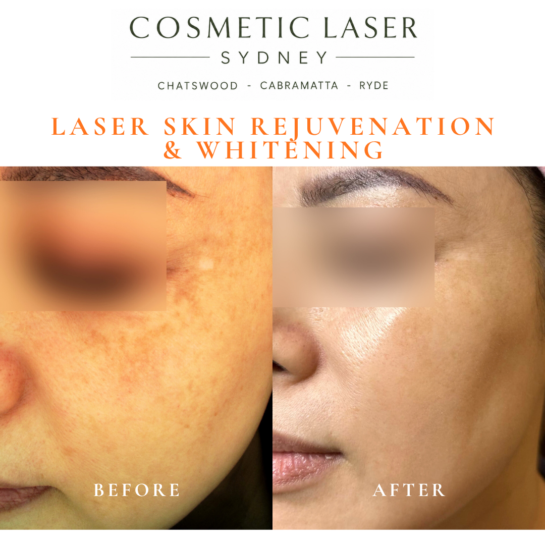 Before and after laser melasma freckle pigmentation treatment and skin whitening by Dr Peter Kim - 20 years experience Sydney (Chatswood, Cabramatta, Ryde)