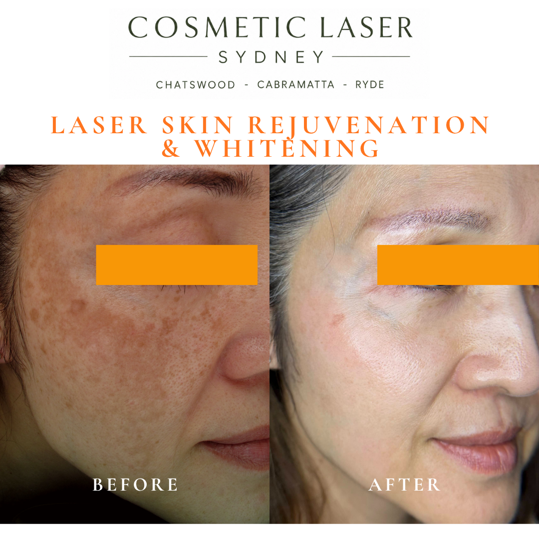 Before and after laser melasma freckle pigmentation treatment and skin whitening by Dr Peter Kim - 20 years experience Sydney (Chatswood, Cabramatta, Ryde)