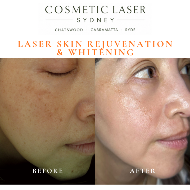 Before and after laser melasma freckle pigmentation treatment and skin whitening by Dr Peter Kim - 20 years experience Sydney (Chatswood, Cabramatta, Ryde)