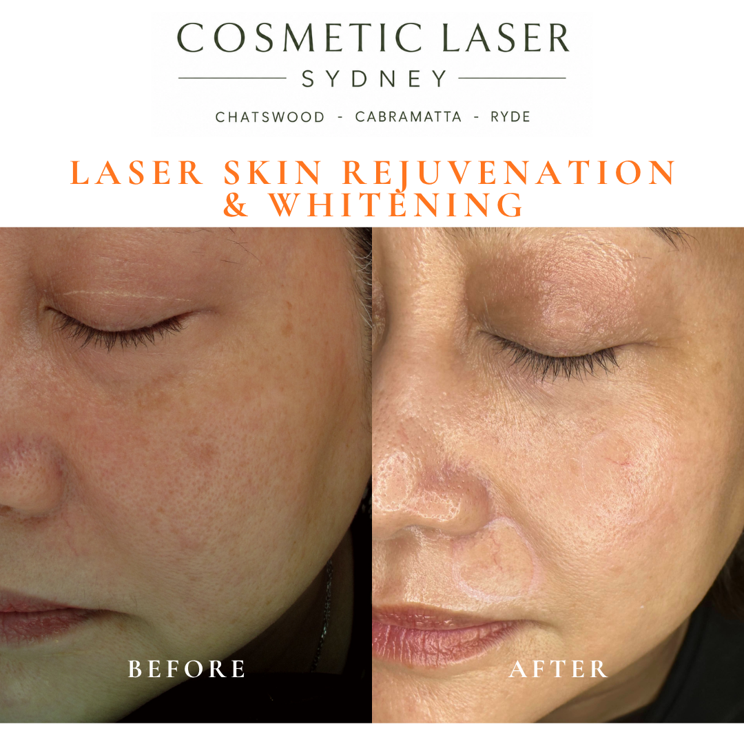 Before and after laser melasma freckle pigmentation treatment and skin whitening by Dr Peter Kim - 20 years experience Sydney (Chatswood, Cabramatta, Ryde)