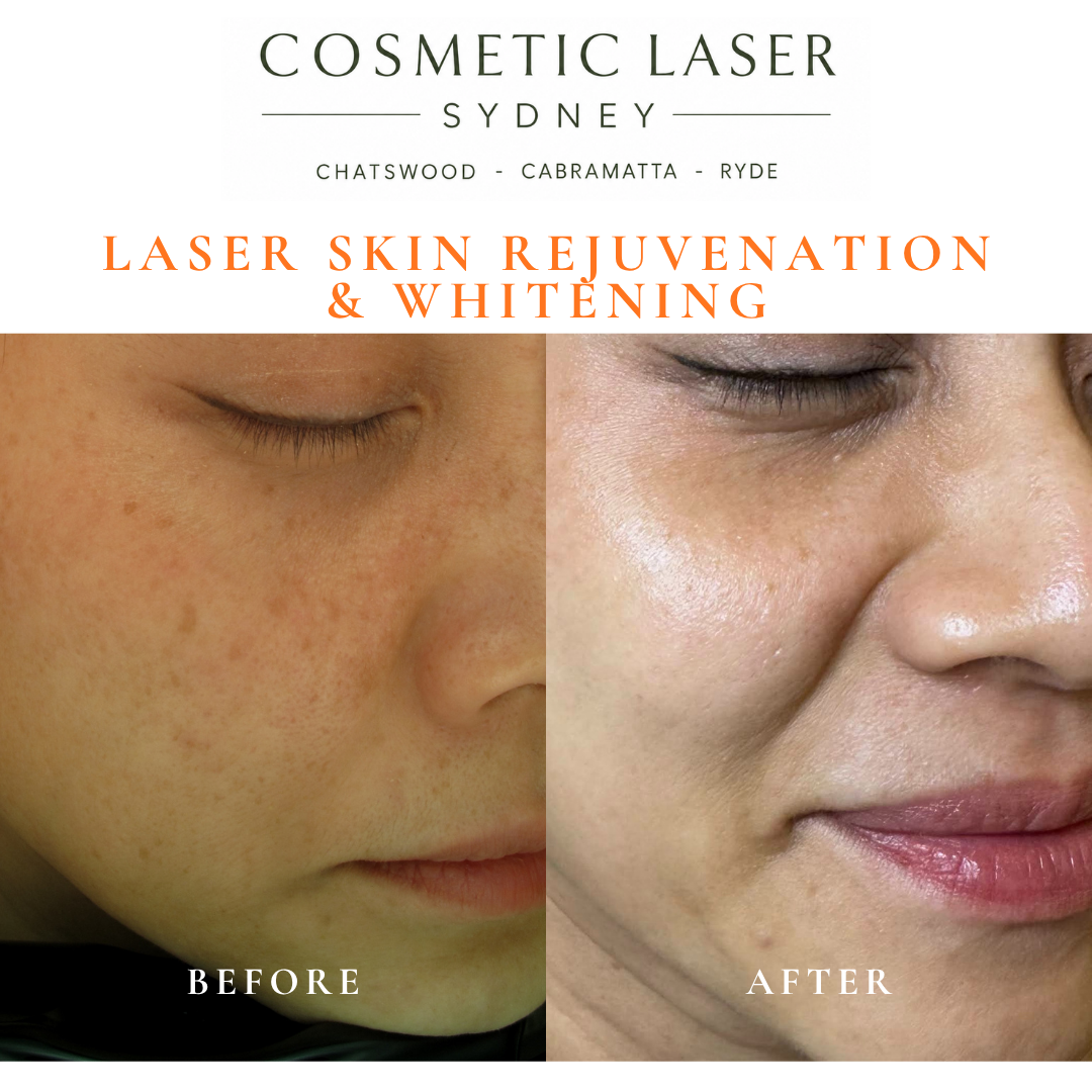 Before and after laser melasma freckle pigmentation treatment and skin whitening by Dr Peter Kim - 20 years experience Sydney (Chatswood, Cabramatta, Ryde)