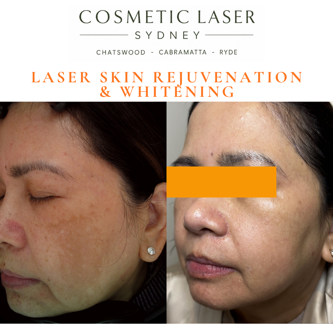 Before and after laser melasma freckle pigmentation treatment and skin whitening by Dr Peter Kim - 20 years experience Sydney (Chatswood, Cabramatta, Ryde)