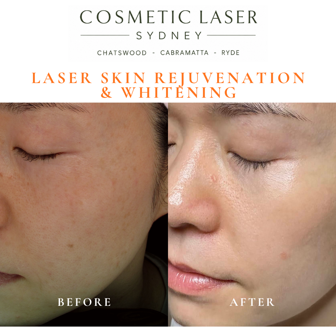Before and after laser melasma freckle pigmentation treatment and skin whitening by Dr Peter Kim - 20 years experience Sydney (Chatswood, Cabramatta, Ryde)