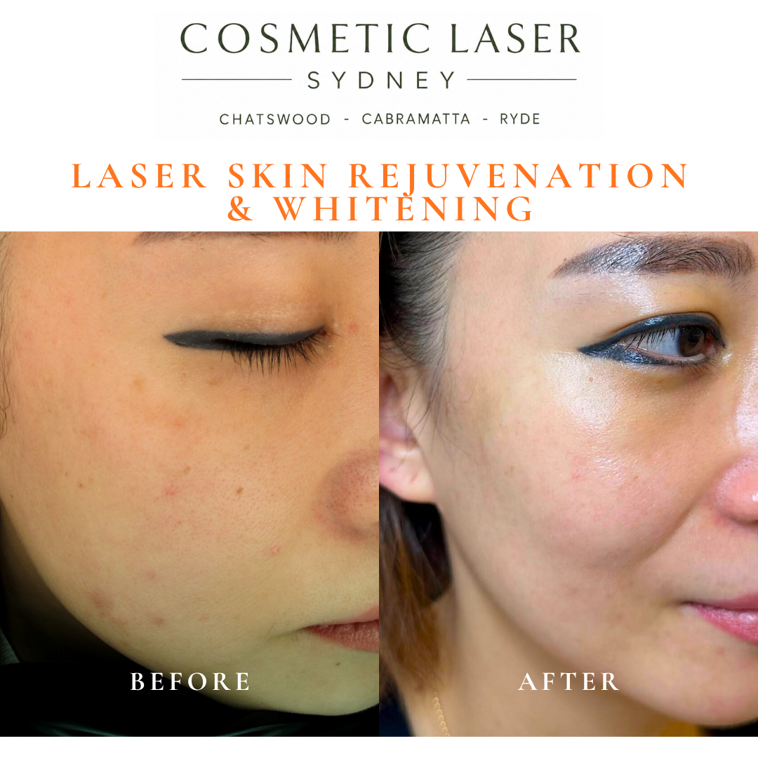 Before and after laser melasma freckle pigmentation treatment and skin whitening by Dr Peter Kim - 20 years experience Sydney (Chatswood, Cabramatta, Ryde)