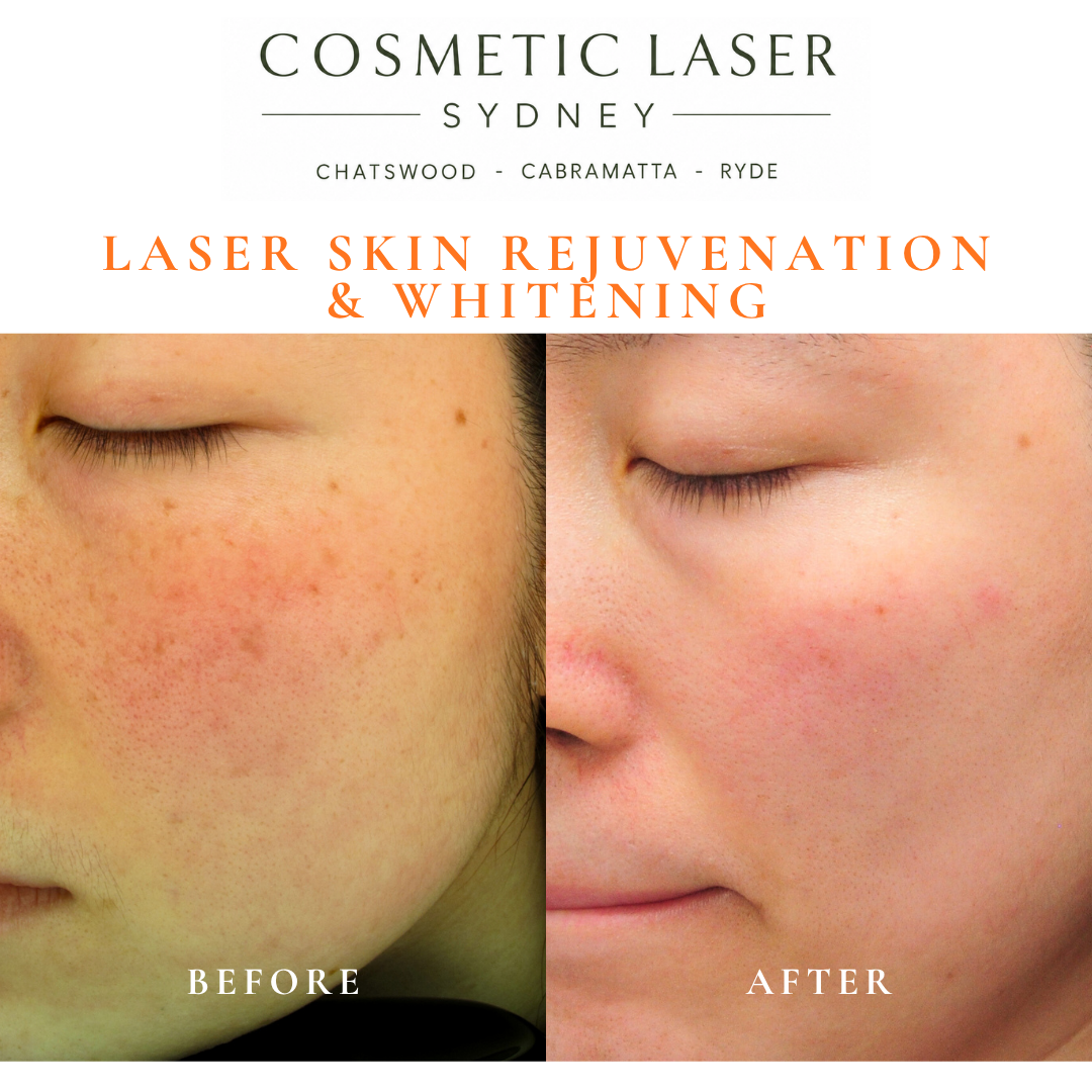 Before and after laser melasma freckle pigmentation treatment and skin whitening by Dr Peter Kim - 20 years experience Sydney (Chatswood, Cabramatta, Ryde)