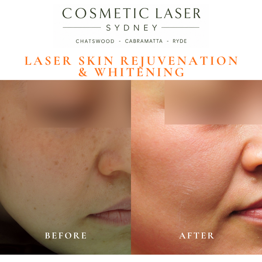 Before and after laser melasma freckle pigmentation treatment and skin whitening by Dr Peter Kim - 20 years experience Sydney (Chatswood, Cabramatta, Ryde)