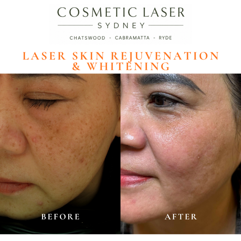 Before and after laser melasma freckle pigmentation treatment and skin whitening by Dr Peter Kim - 20 years experience Sydney (Chatswood, Cabramatta, Ryde)