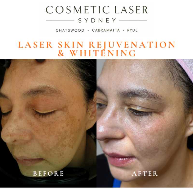Before and after laser melasma freckle pigmentation treatment and skin whitening by Dr Peter Kim - 20 years experience Sydney (Chatswood, Cabramatta, Ryde)