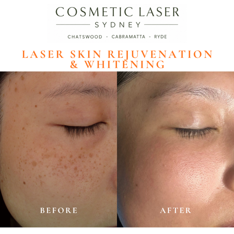 Before and after laser melasma freckle pigmentation treatment and skin whitening by Dr Peter Kim - 20 years experience Sydney (Chatswood, Cabramatta, Ryde)