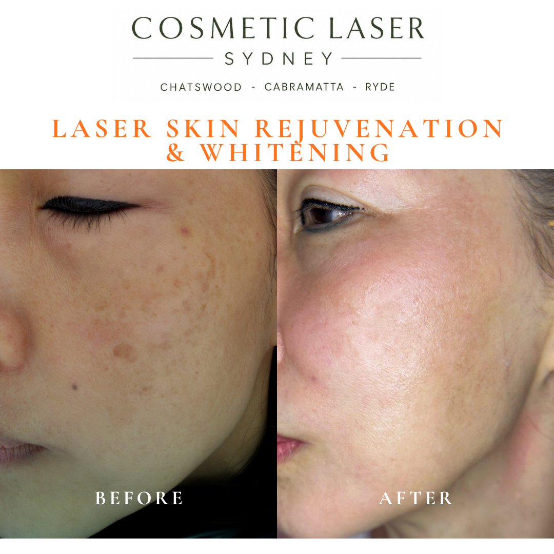 Before and after laser melasma freckle pigmentation treatment and skin whitening by Dr Peter Kim - 20 years experience Sydney (Chatswood, Cabramatta, Ryde)