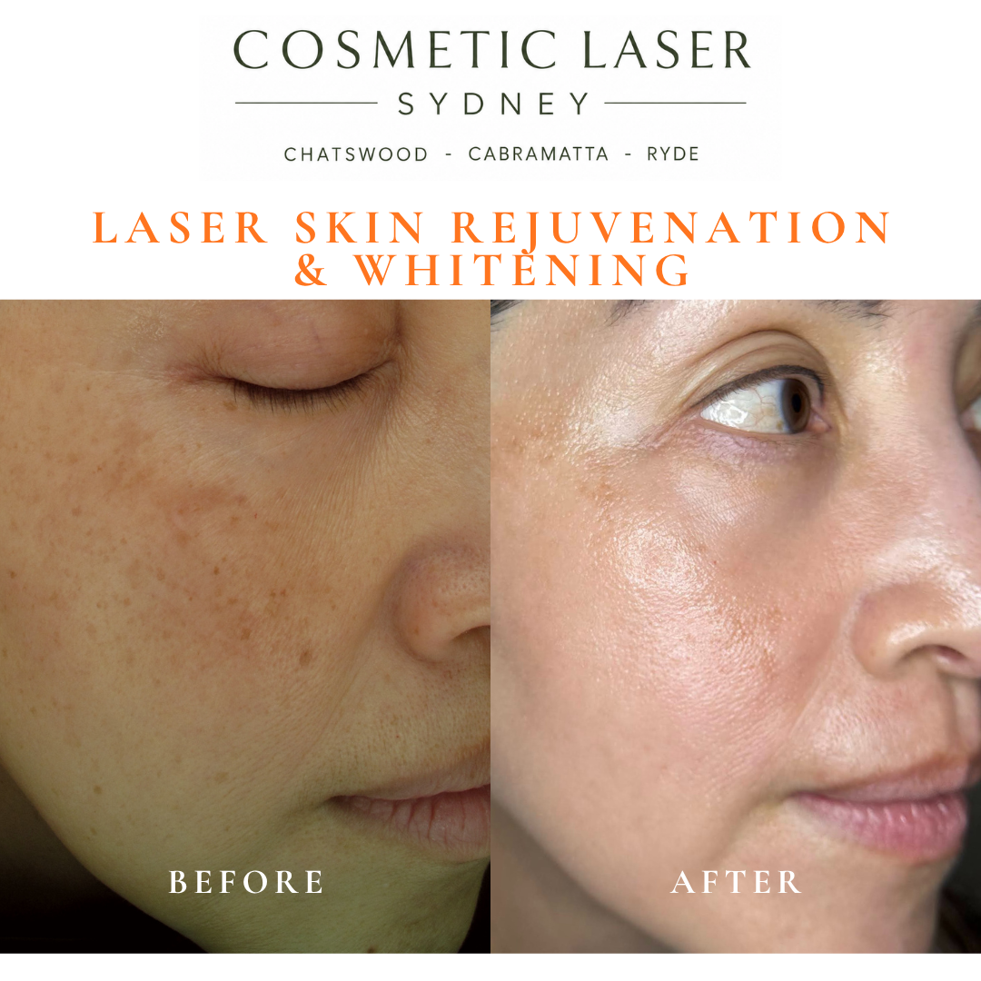 Before and after laser melasma freckle pigmentation treatment and skin whitening by Dr Peter Kim - 20 years experience Sydney (Chatswood, Cabramatta, Ryde)