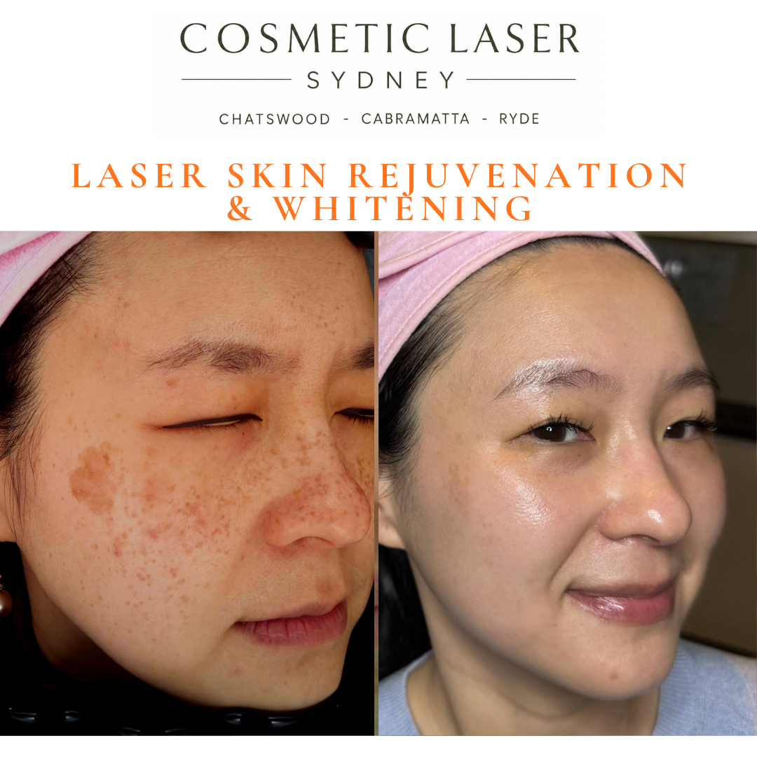 Before and after laser treatment for melasma, freckles and pigmentation on all skin types including Asian & ethnic skin types. 20 years experience in laser skin rejuvenation and whitening. Chatswood, Cabramatta & Ryde, Sydney