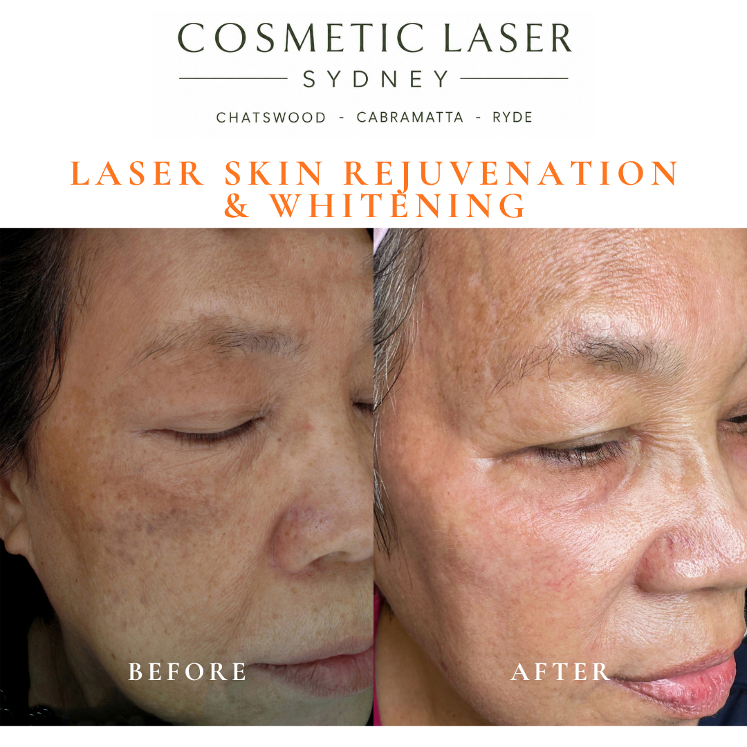Before and after laser melasma freckle pigmentation treatment and skin whitening by Dr Peter Kim - 20 years experience Sydney (Chatswood, Cabramatta, Ryde)