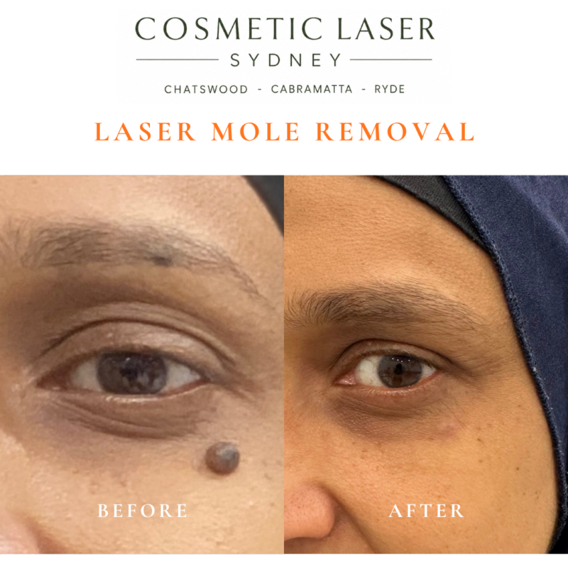 Before and after comparison of facial laser mole removal treatment, highlighting the removal of several moles with minimal scarring