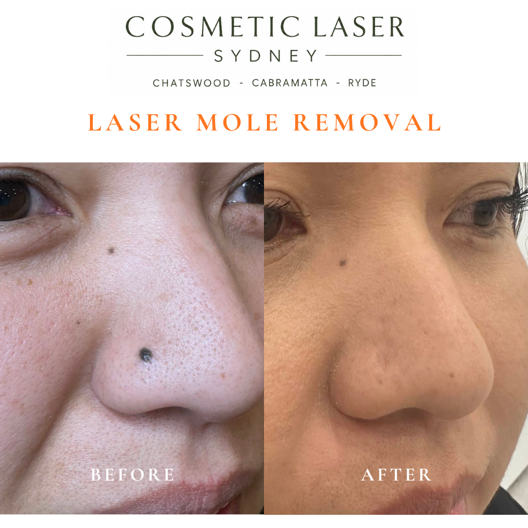 Before and after comparison of facial laser mole removal treatment, highlighting the removal of several moles with minimal scarring