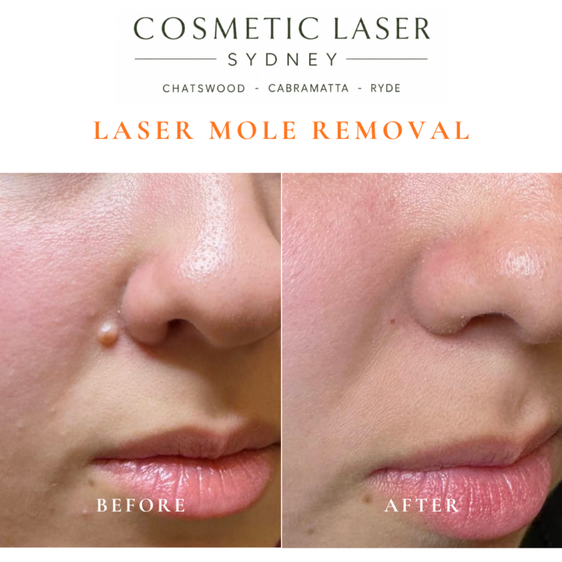 Before and after comparison of facial laser mole removal treatment, highlighting the removal of several moles with minimal scarring