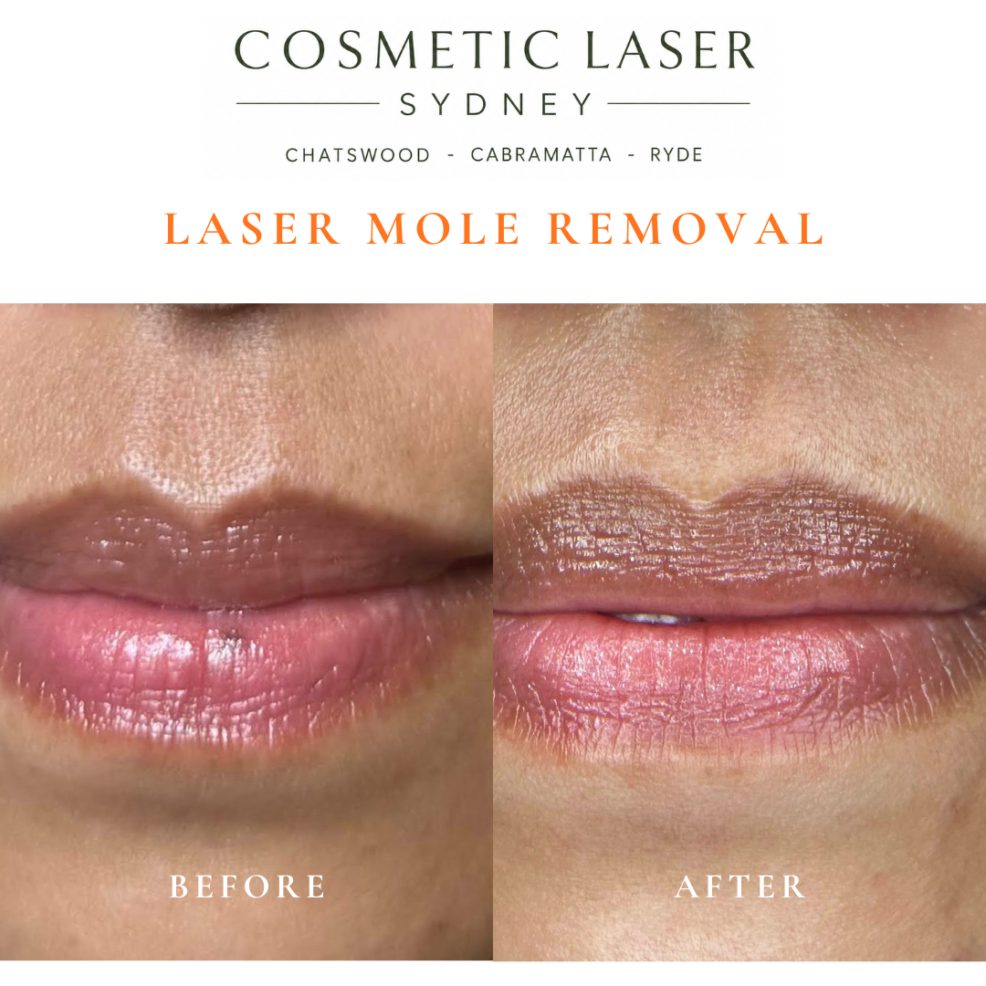 Before and after comparison of facial laser mole removal treatment, highlighting the removal of several moles with minimal scarring