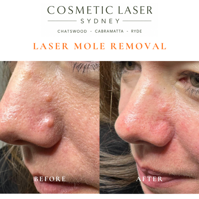 Before and after comparison of facial laser mole removal treatment, highlighting the removal of several moles with minimal scarring