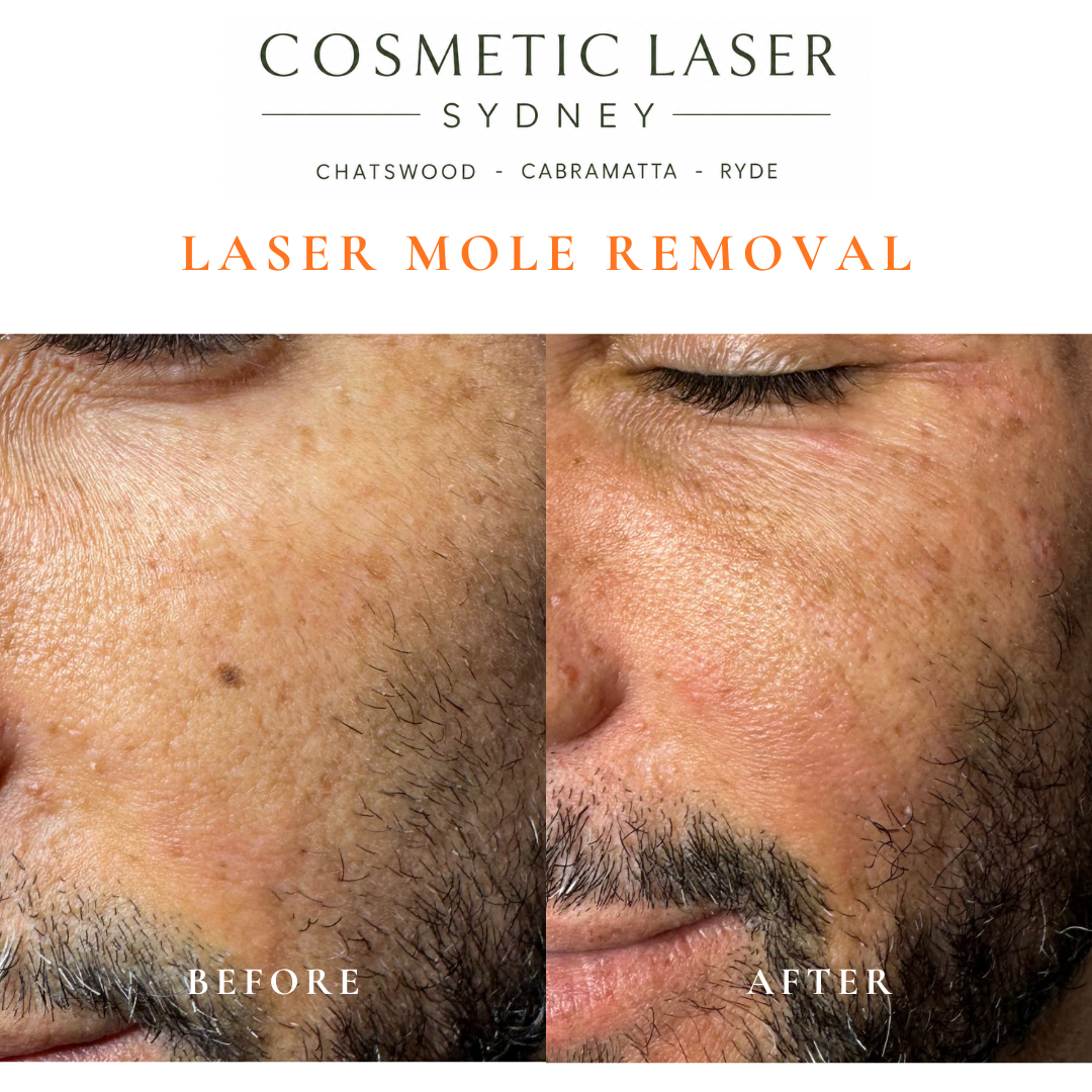 Before and after comparison of facial laser mole removal treatment, highlighting the removal of several moles with minimal scarring