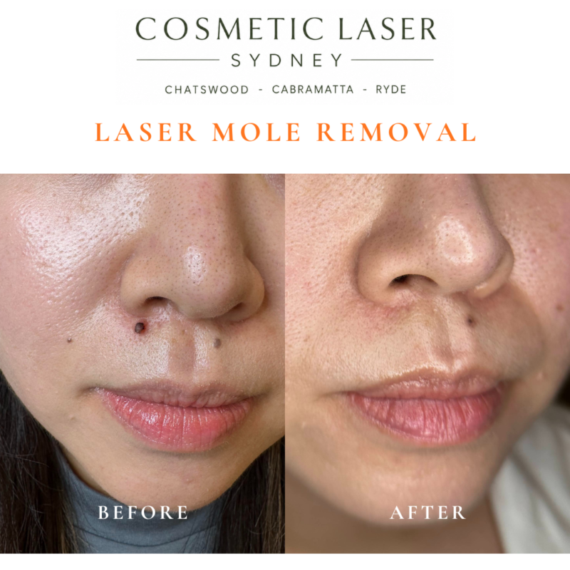 Before and after comparison of facial laser mole removal treatment, highlighting the removal of several moles with minimal scarring