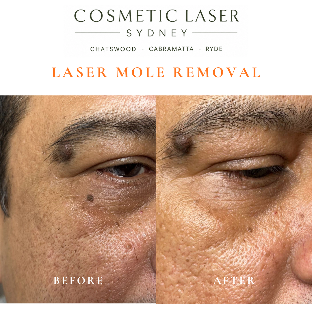 Before and after comparison of facial laser mole removal treatment, highlighting the removal of several moles with minimal scarring