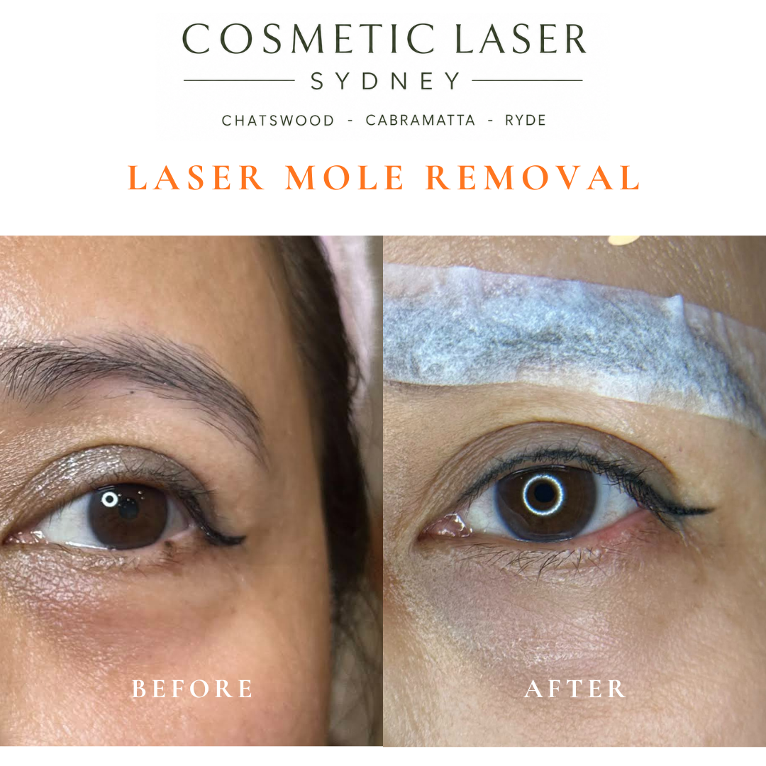 Before and after comparison of facial laser mole removal treatment, highlighting the removal of several moles with minimal scarring