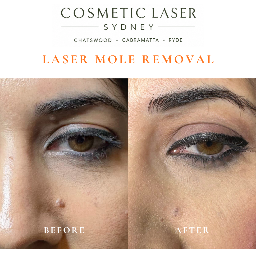 Before and after comparison of facial laser mole removal treatment, highlighting the removal of several moles with minimal scarring