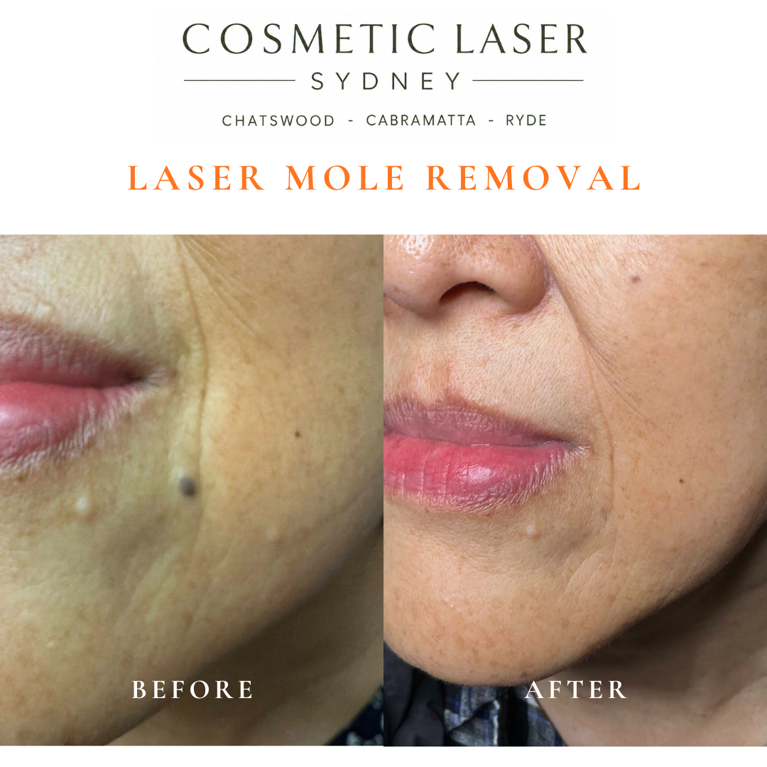 Before and after comparison of facial laser mole removal treatment, highlighting the removal of several moles with minimal scarring