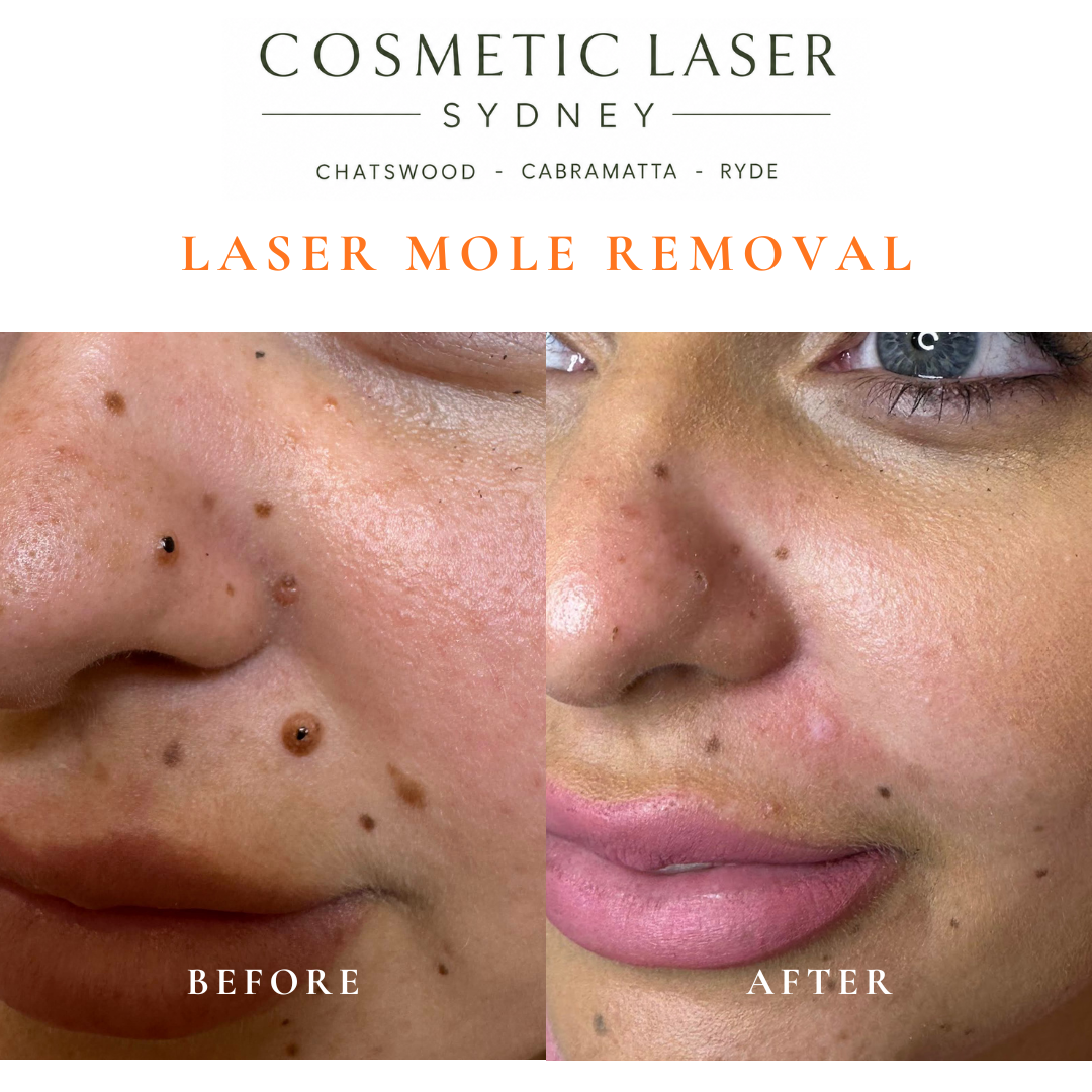 Before and after comparison of facial laser mole removal treatment, highlighting the removal of several moles with minimal scarring
