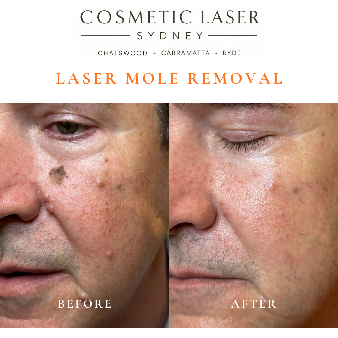 Before and after comparison of facial laser mole removal treatment, highlighting the removal of several moles with minimal scarring