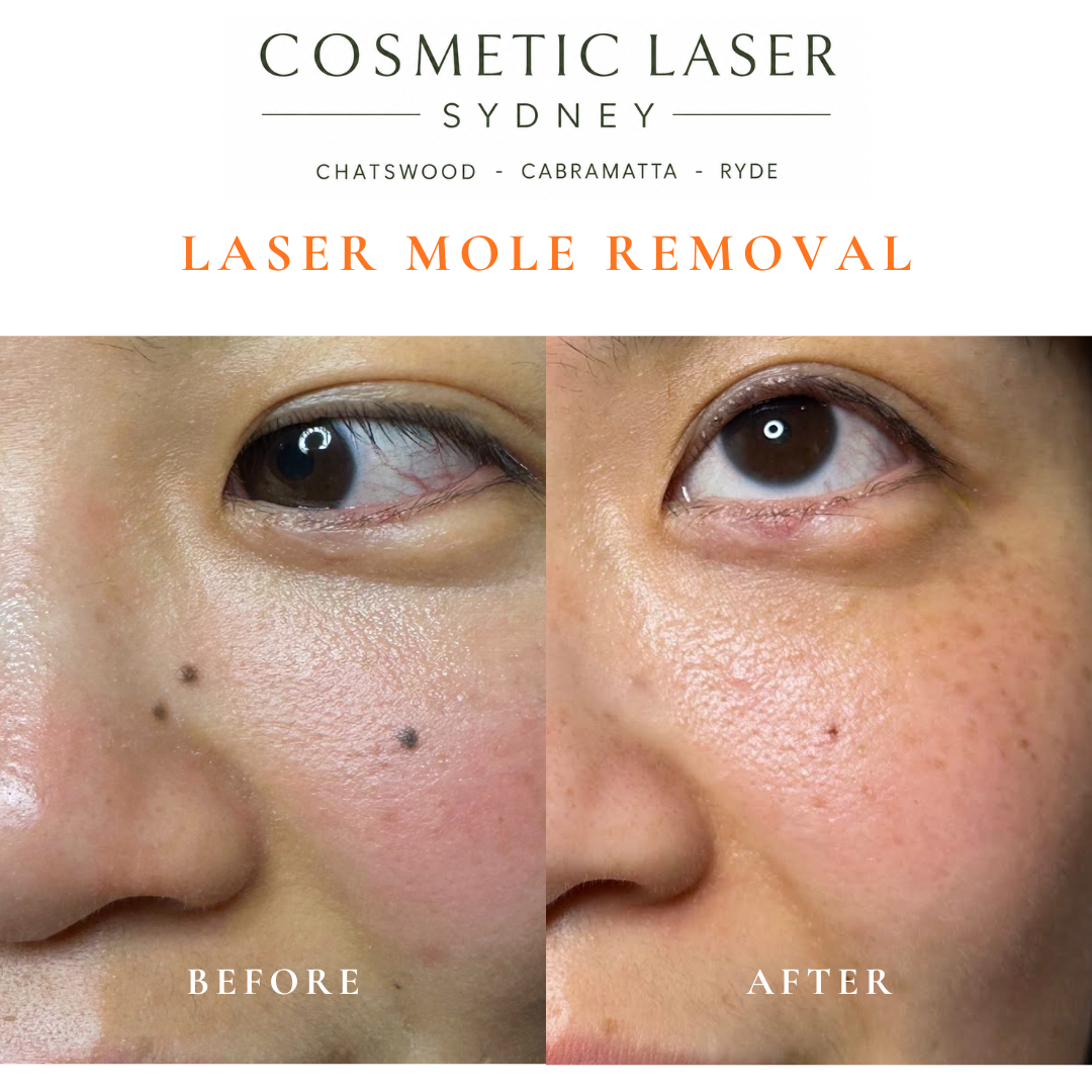 Before and after comparison of facial laser mole removal treatment, highlighting the removal of several moles with minimal scarring