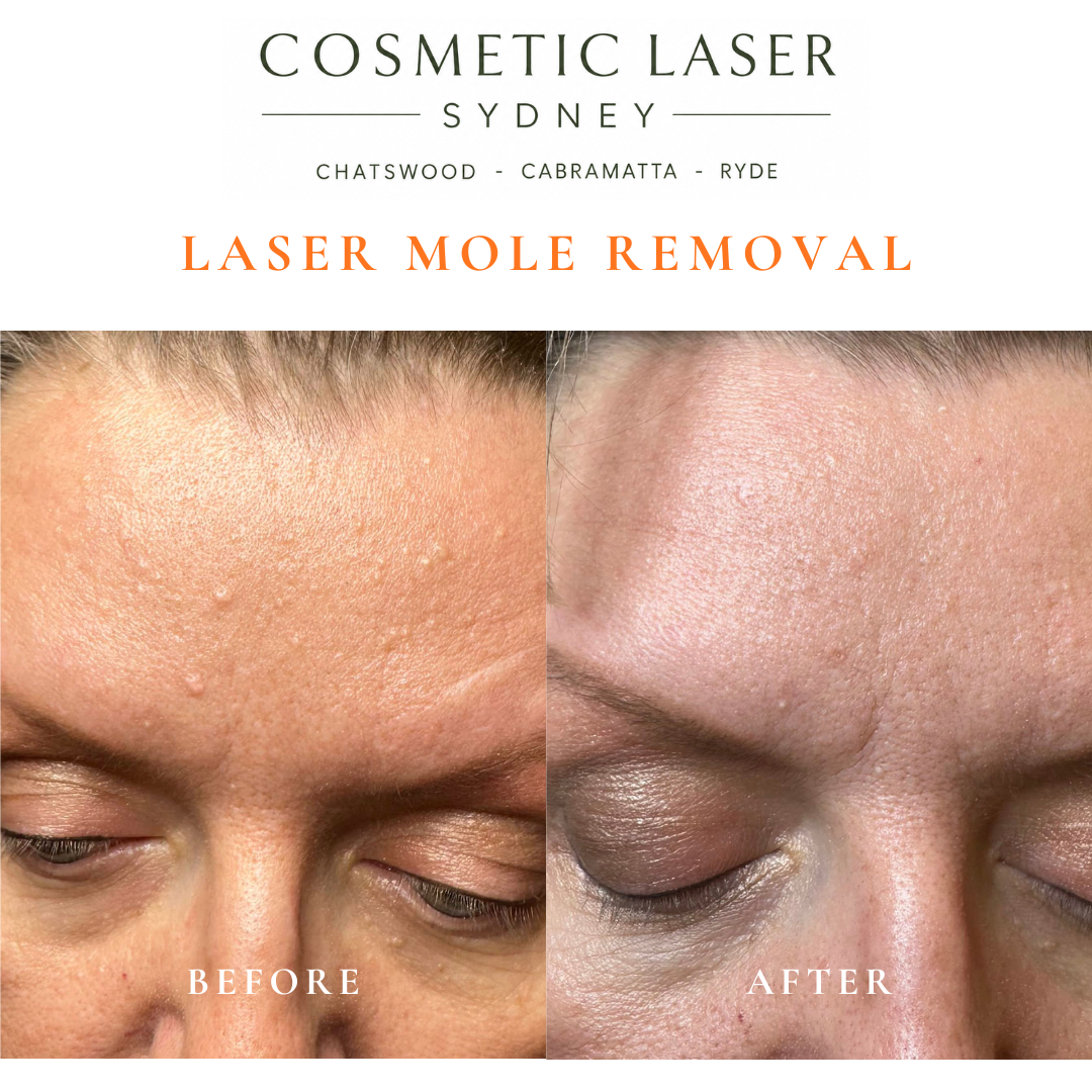 Before and after comparison of facial laser mole removal treatment, highlighting the removal of several moles with minimal scarring