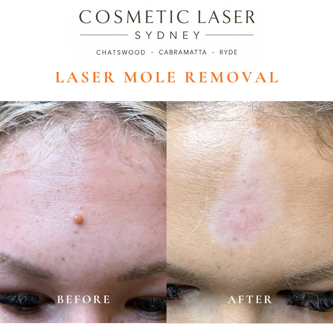 Before and after comparison of facial laser mole removal treatment, highlighting the removal of several moles with minimal scarring