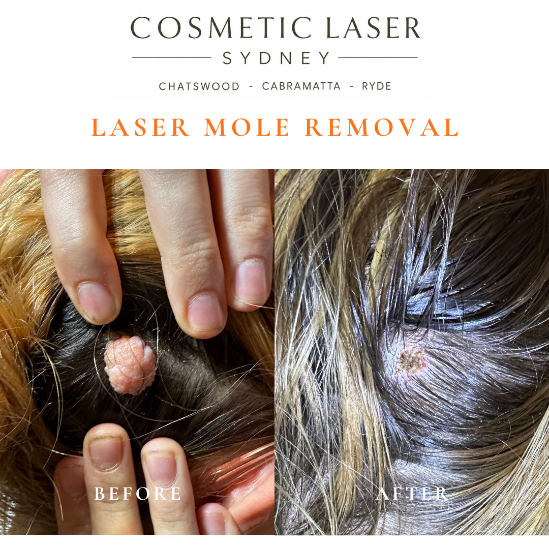 Before and after comparison of facial laser mole removal treatment, highlighting the removal of several moles with minimal scarring