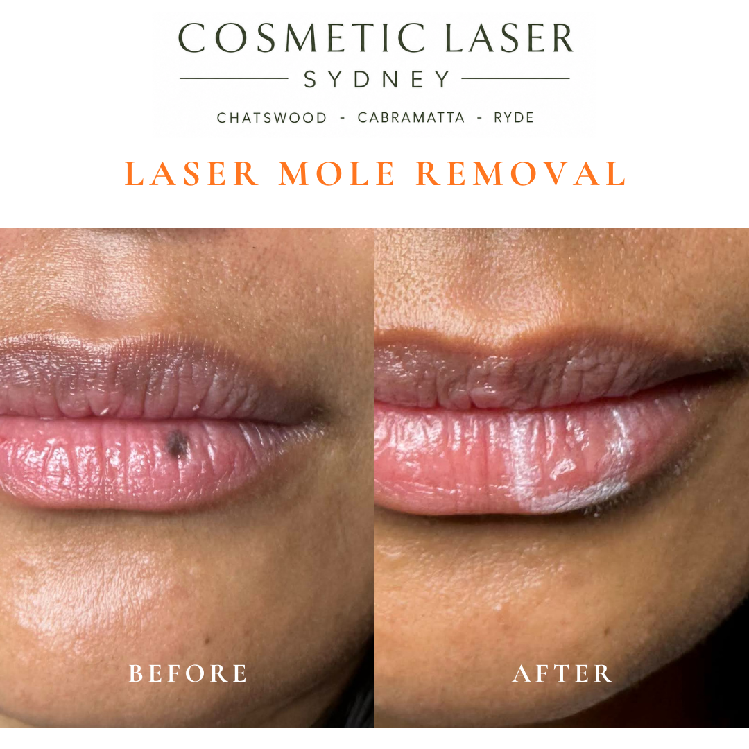 Before and after comparison of facial laser mole removal treatment, highlighting the removal of several moles with minimal scarring