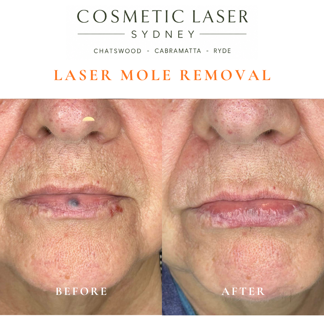 Before and after comparison of facial laser mole removal treatment, highlighting the removal of several moles with minimal scarring