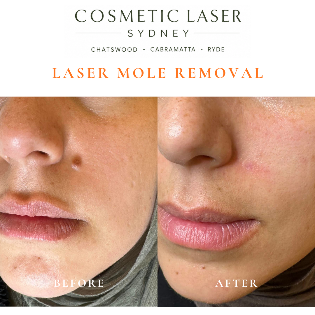 Before and after comparison of facial laser mole removal treatment, highlighting the removal of several moles with minimal scarring