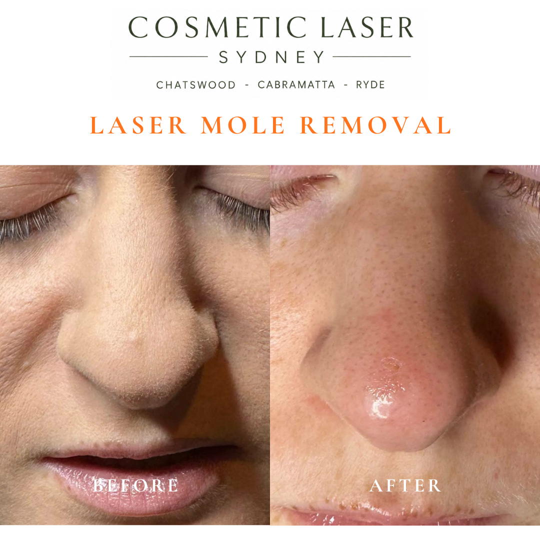 Before and after comparison of facial laser mole removal treatment, highlighting the removal of several moles with minimal scarring