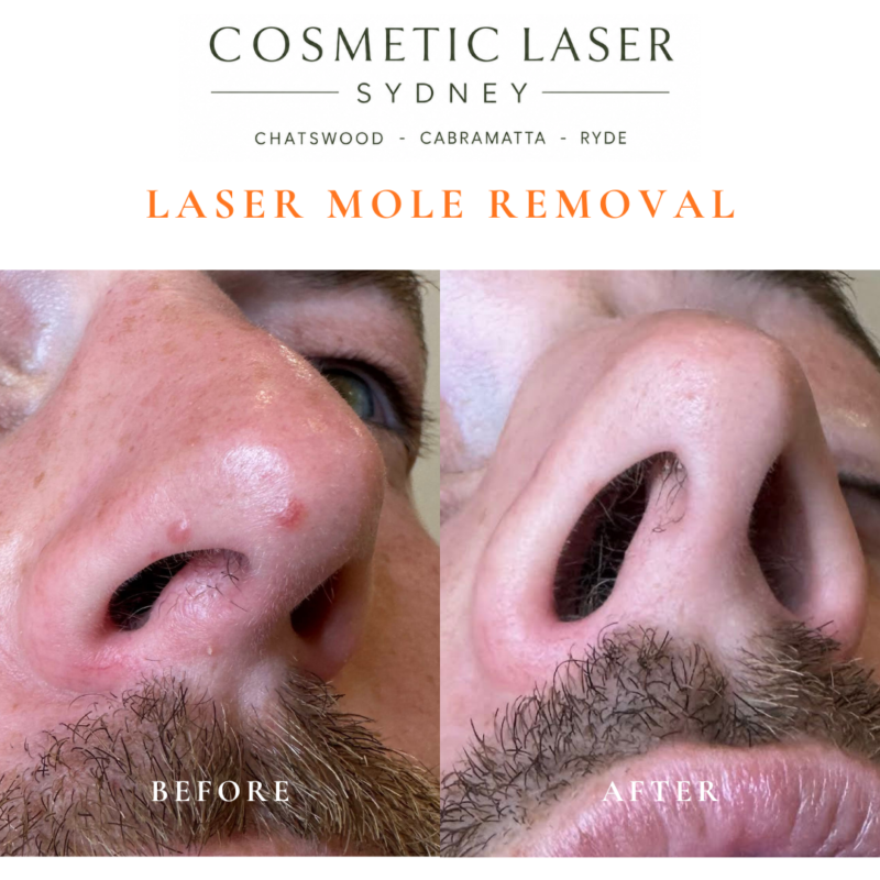 Before and after comparison of facial laser mole removal treatment, highlighting the removal of several moles with minimal scarring