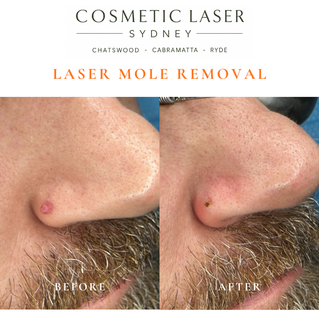 Before and after comparison of facial laser mole removal treatment, highlighting the removal of several moles with minimal scarring