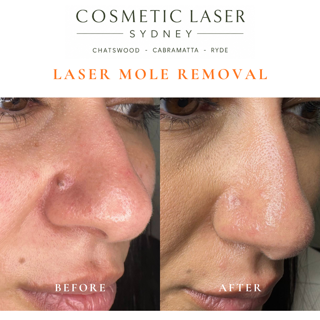 Before and after comparison of facial laser mole removal treatment, highlighting the removal of several moles with minimal scarring