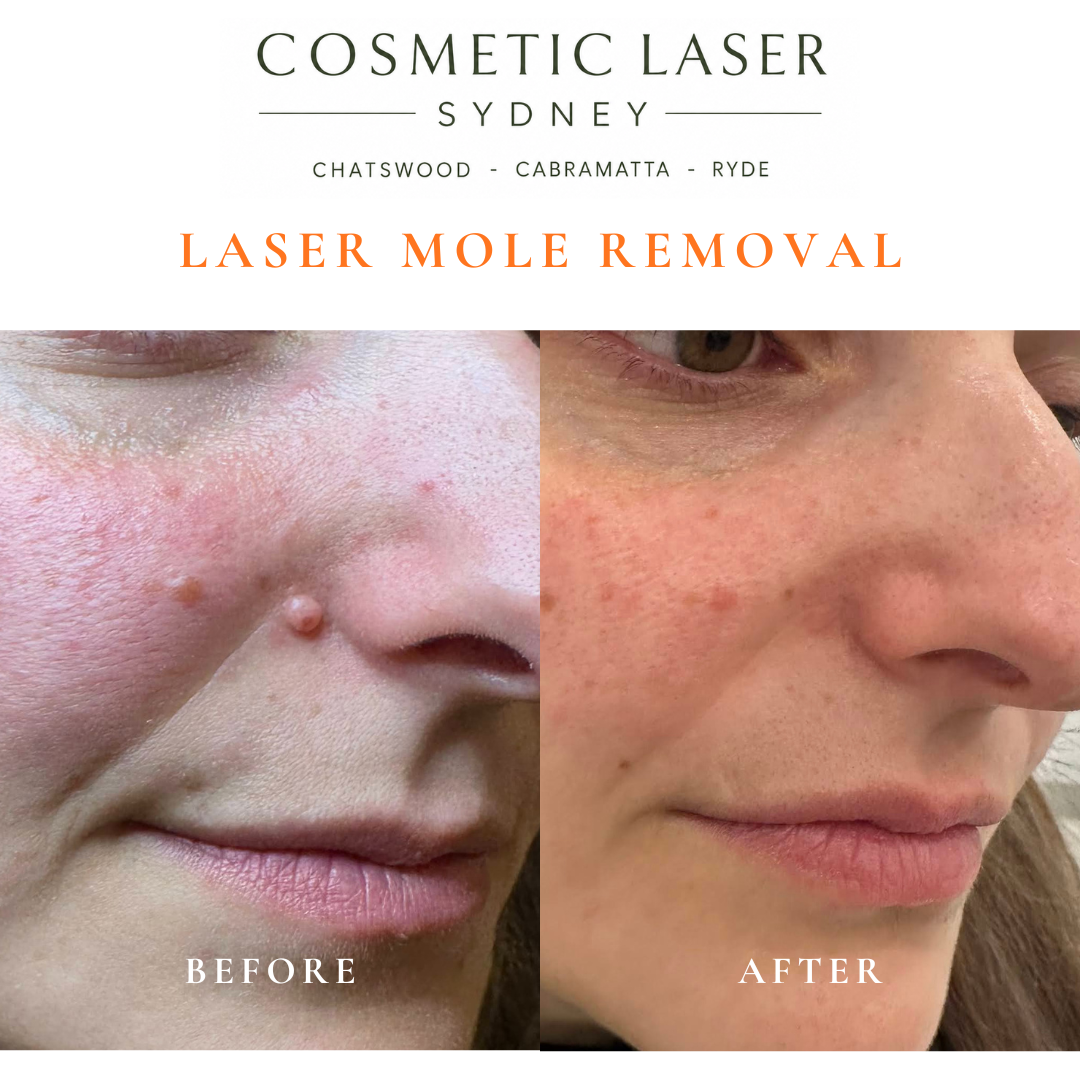 Before and after comparison of facial laser mole removal treatment, highlighting the removal of several moles with minimal scarring