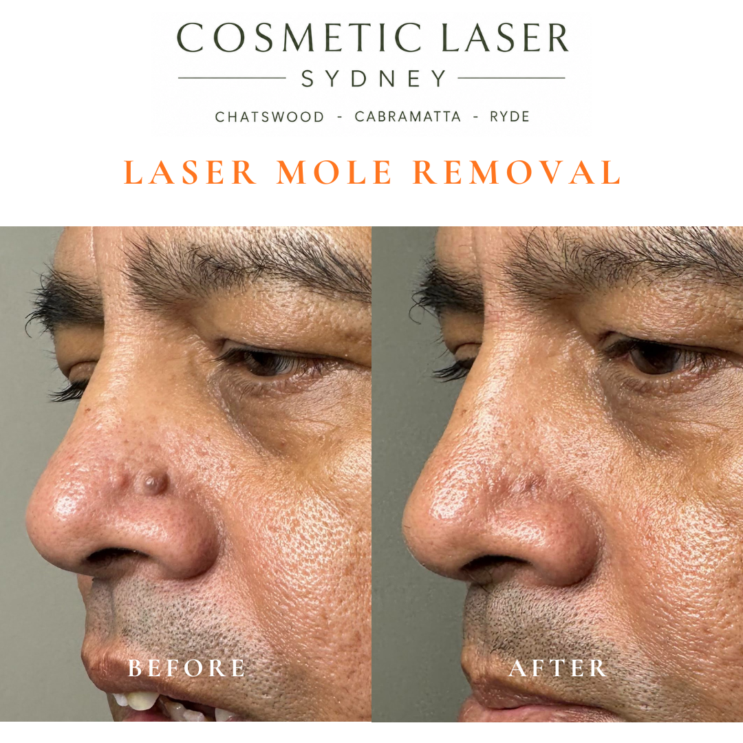 Before and after comparison of facial laser mole removal treatment, highlighting the removal of several moles with minimal scarring