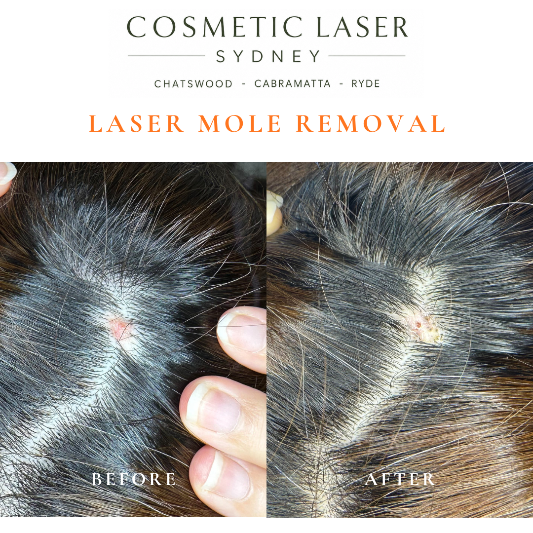 Before and after comparison of facial laser mole removal treatment, highlighting the removal of several moles with minimal scarring