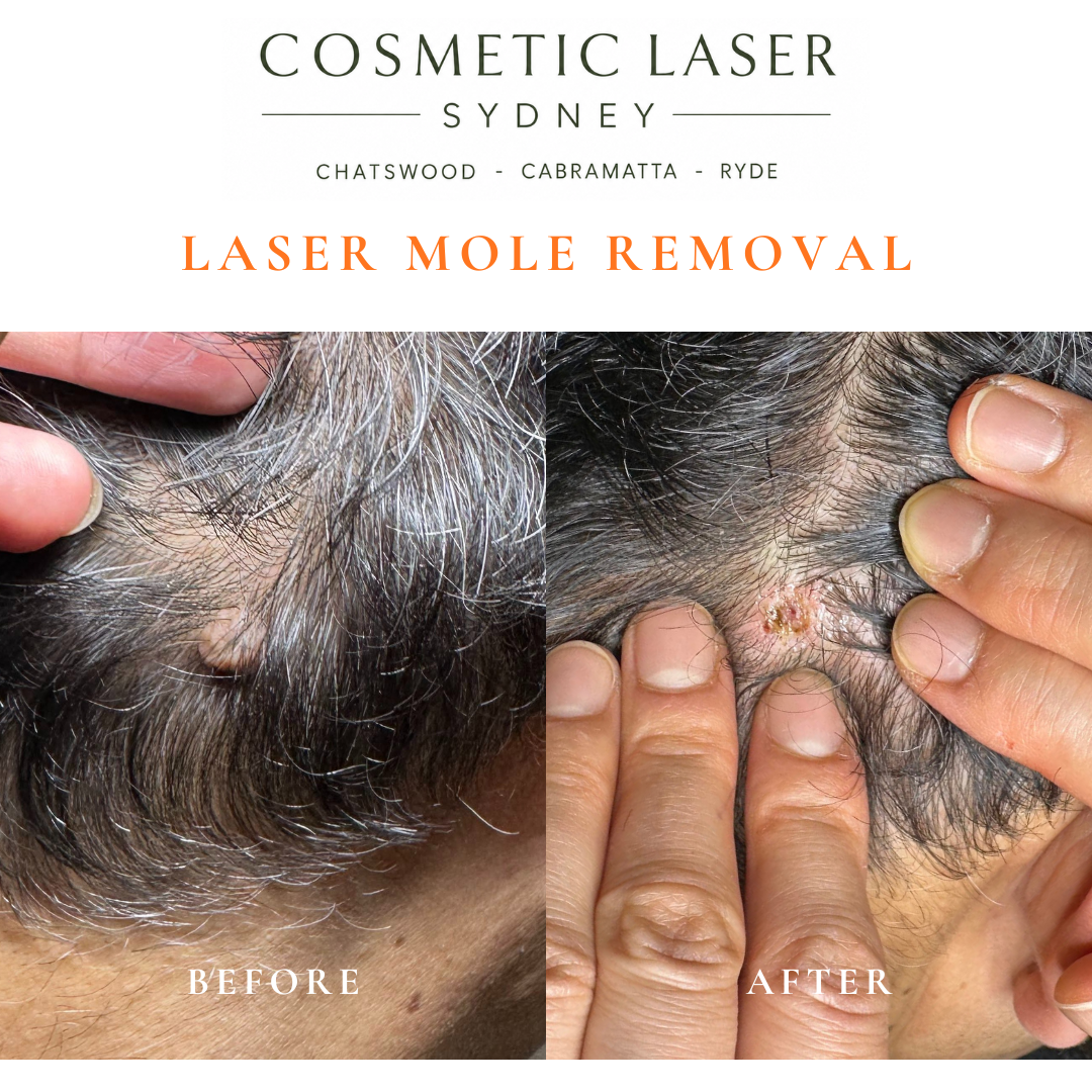 Before and after comparison of facial laser mole removal treatment, highlighting the removal of several moles with minimal scarring