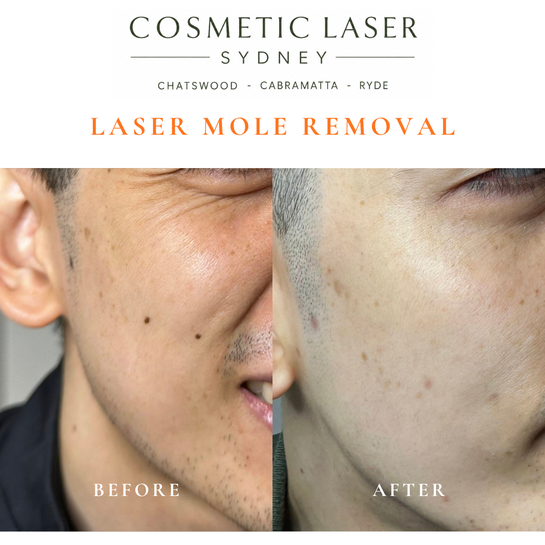 best cosmetic laser in sydney for moles in asian skin types chatswood cabramatta sydney