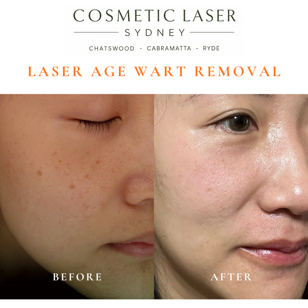 Cosmetic laser clinic in Sydney specialising in seborrhoeic keratosis and age wart laser removal for all skin types. See thousands of before and after photos.