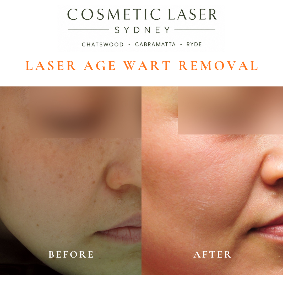 Cosmetic laser clinic in Sydney specialising in seborrhoeic keratosis and age wart laser removal for all skin types. See thousands of before and after photos.
