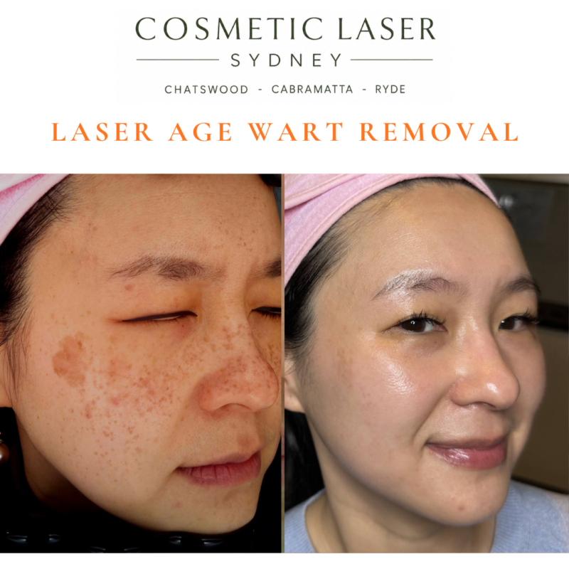 Cosmetic laser clinic in Sydney specialising in seborrhoeic keratosis and age wart laser removal for all skin types. See thousands of before and after photos.